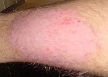 Psoriasis vulgaris - typische, handtellergroße psoriatische Plaque am Bein